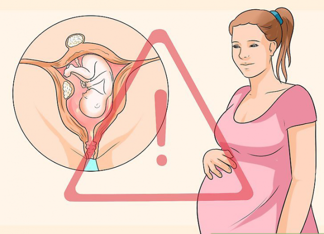 U xơ tử cung khi mang thai- Những điều bà bầu cần biết