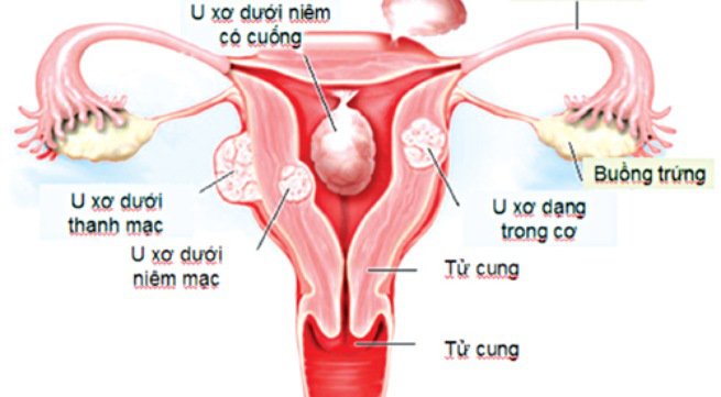 U xơ tử cung có mang thai được không