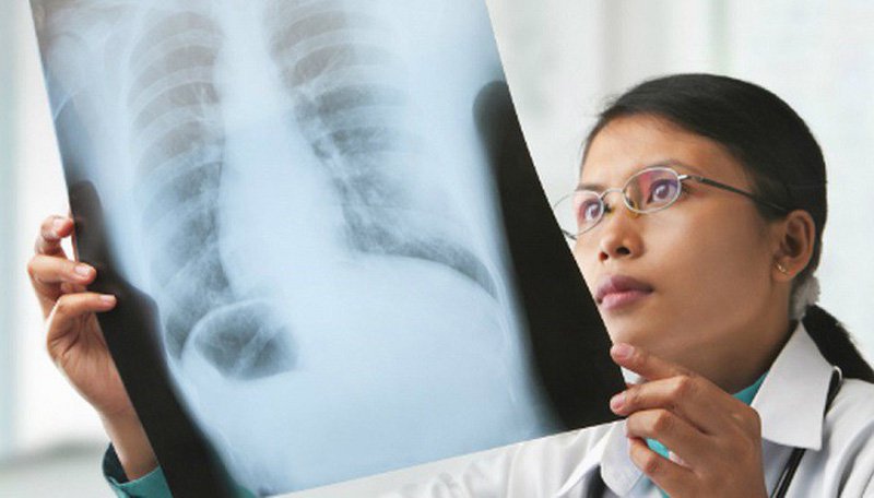 Ung thư phổi có thể được chẩn đoán ở giai đoạn sớm không?