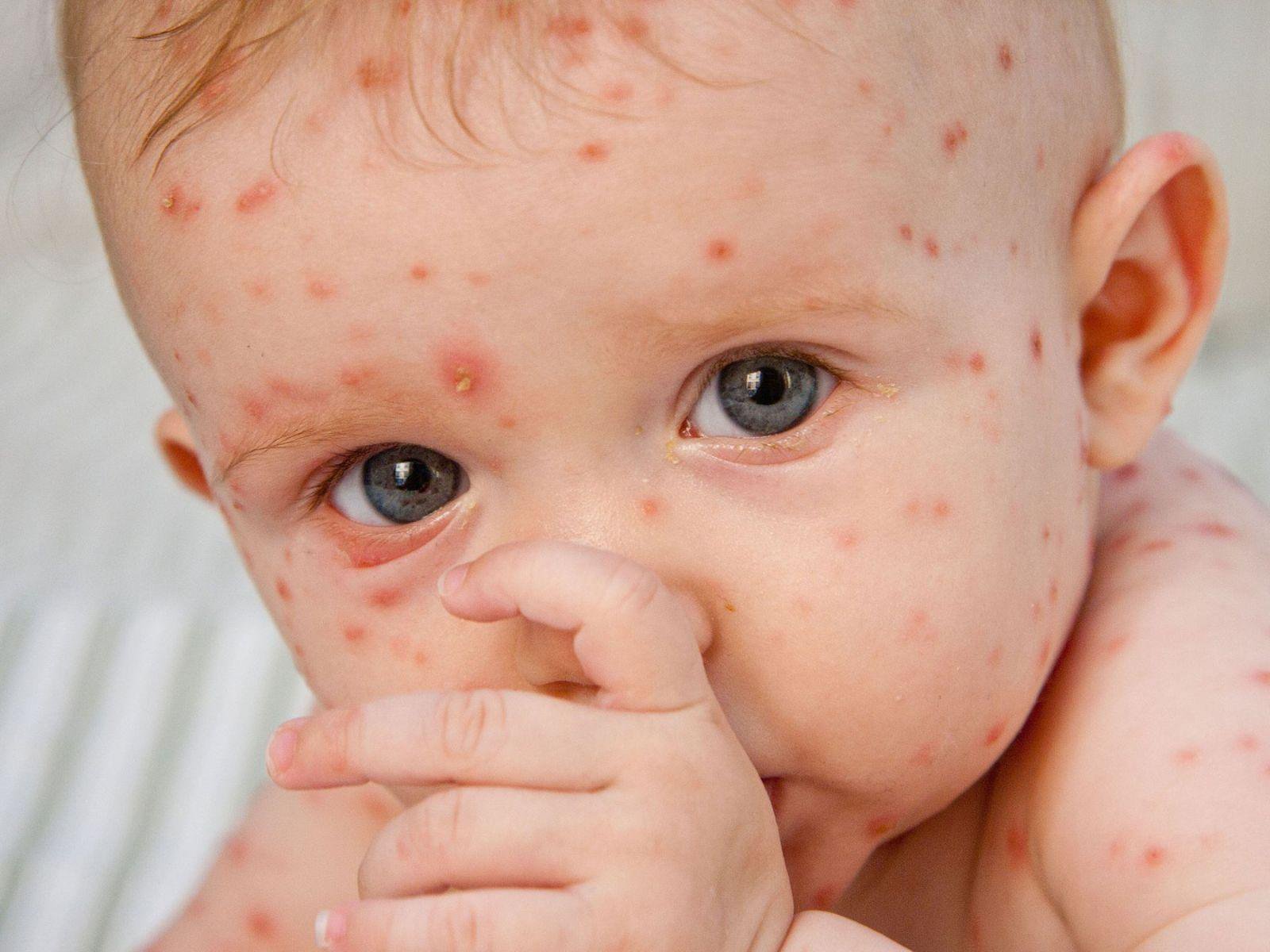 Phân biệt các dấu hiệu của bệnh sốt phát ban với bệnh sởi