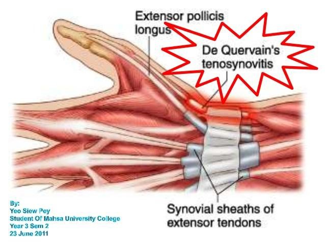 Hội chứng De Quervain :Viêm bao gân ở mỏm trâm quay