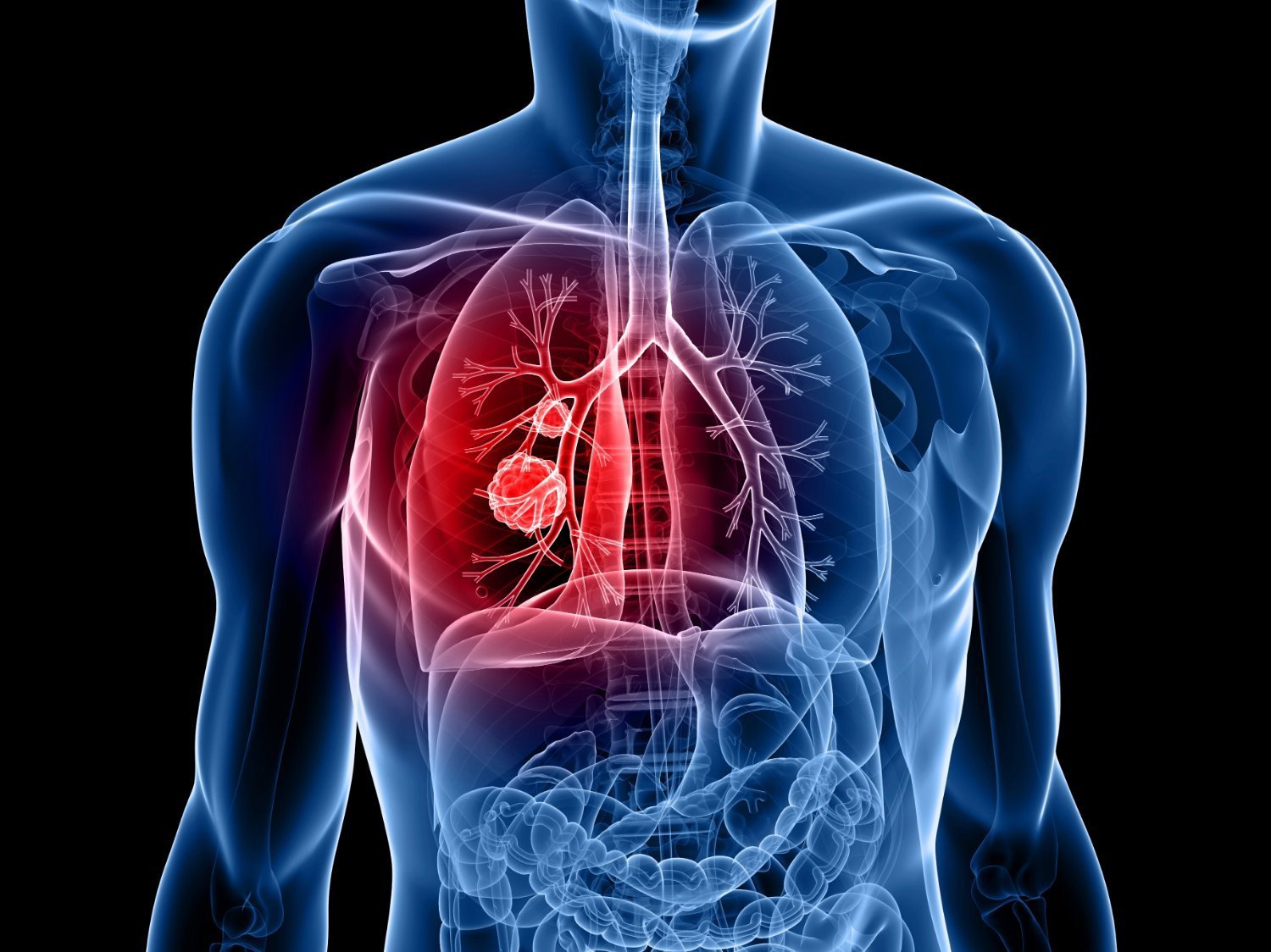 Tiên lượng điều trị ung thư phổi giai đoạn cuối