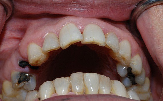 Sâu răng hàm