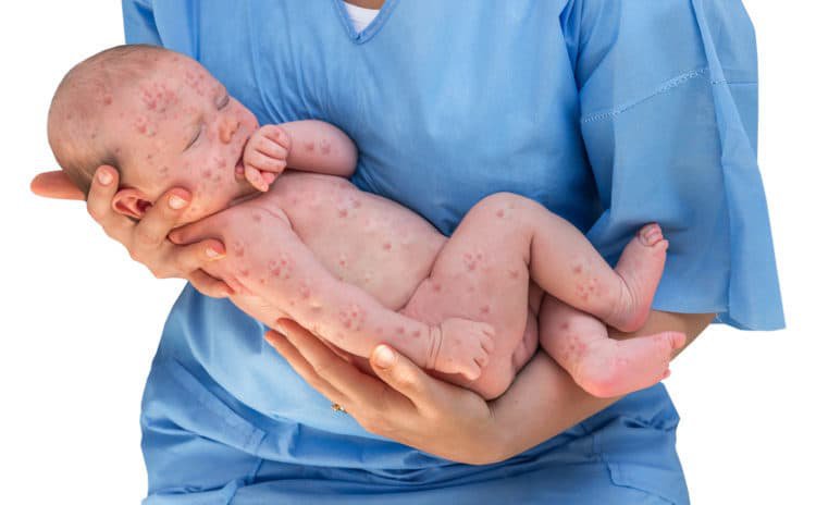 What is congenital rubella syndrome?