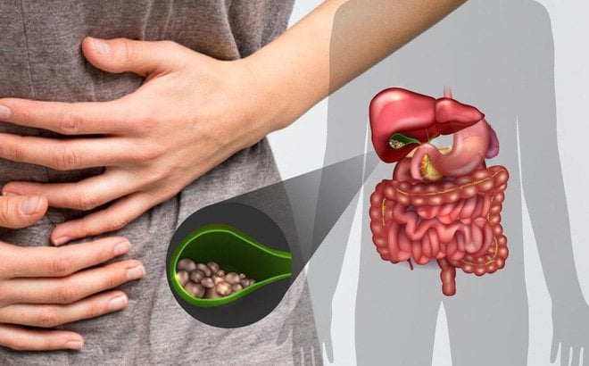 How are gallstones formed and how are they treated?