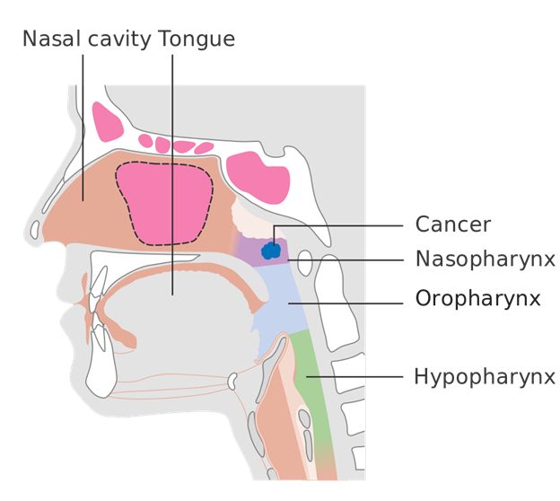 Hình ảnh ung thư vòm họng qua các giai đoạn