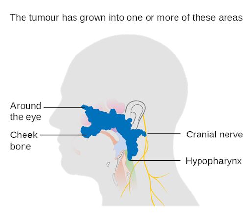 Hình ảnh ung thư vòm họng qua các giai đoạn