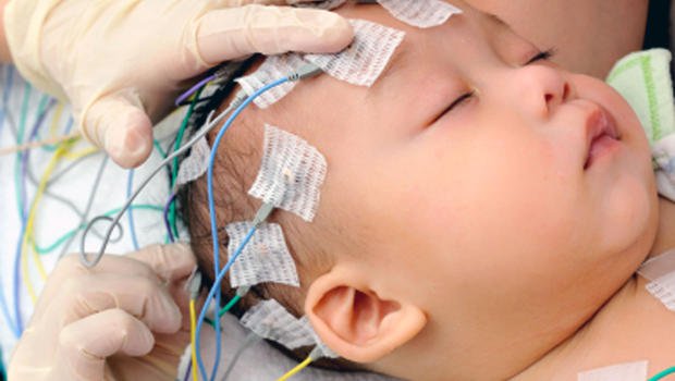 Điện não đồ đóng vai trò quan trọng trong chẩn đoán động kinh ở trẻ sơ sinh