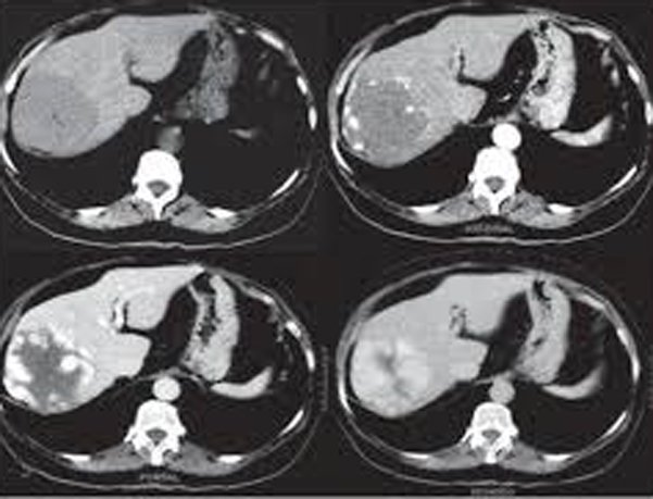 Hình ảnh minh họa khối u máu trong gan được chẩn đoán bằng CT