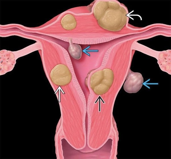 Uterine fibroids remove a lot of blood loss?