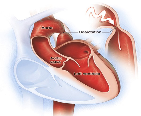 Tăng huyết áp do hẹp eo động mạch chủ
