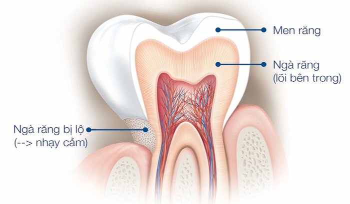 Răng nhạy cảm hình thành khi phần ngà răng bị ăn mòn