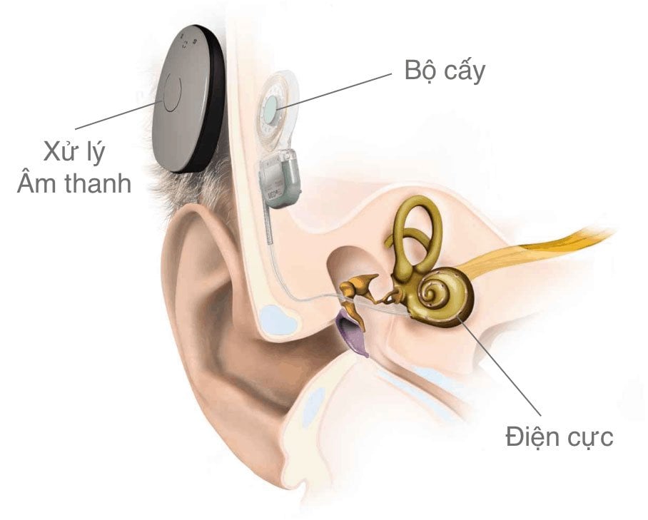 Cấy ghép điện cực ốc tai