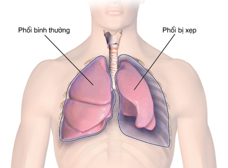 Xẹp phổi kèm khó thở phải làm sao?