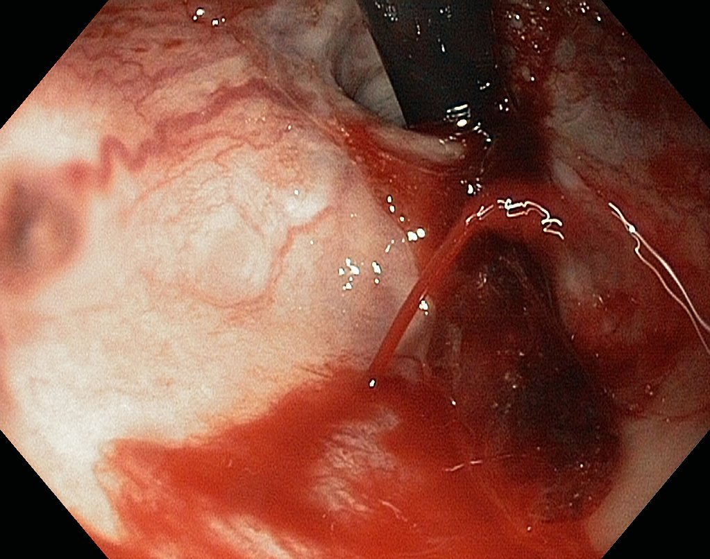 Hình ảnh nội soi của vỡ tĩnh mạch thực quản