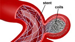 nút coil nội mạch