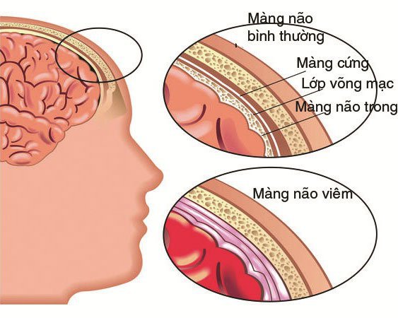 Bệnh viêm màng não do vi khuẩn não mô cầu gây ra