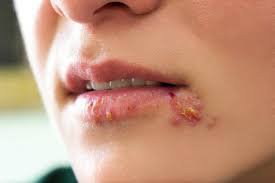 Bị herpes môi