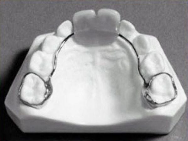 Khâu được gắn cố định vào răng số 6