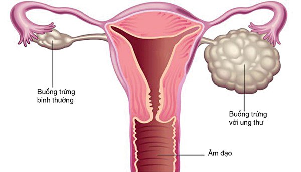 Người mắc ung thư buồng trứng có khả năng cao mức ung thư vú