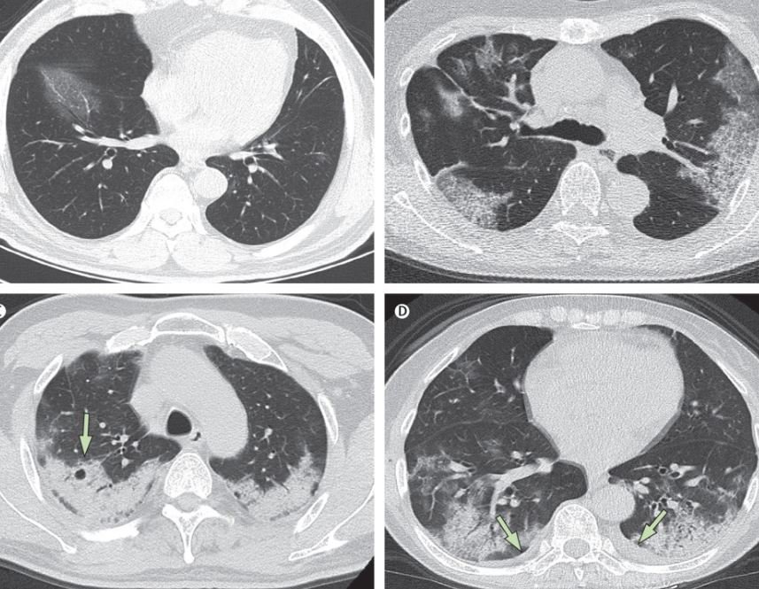 MRI phổi