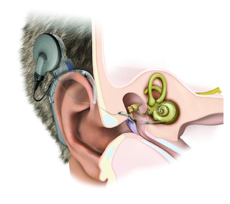 MRI chống chỉ định cho trường hợp có cấy ốc tai