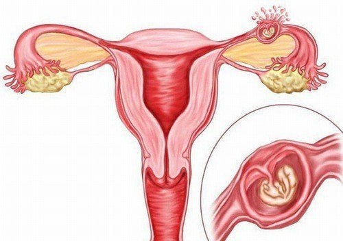 Tại sao phụ nữ khi có thai có thể bị thai ngoài tử cung?