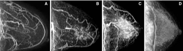 Hình ảnh MRI các mức độ ngấm thuốc mô vú