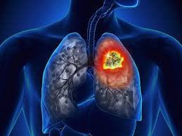 ung thư phổi không tế bào nhỏ giai đoạn di căn