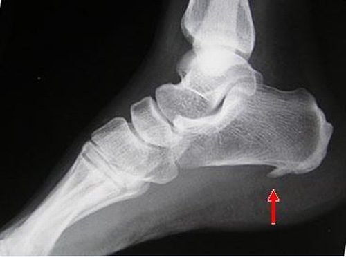 X quang vùng gót chân