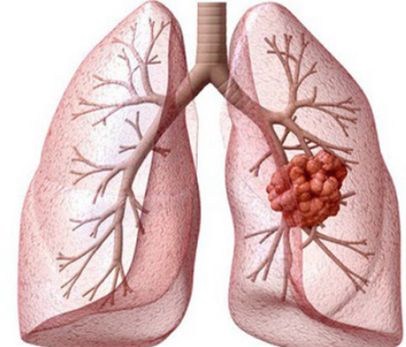 Ung thư phổi
