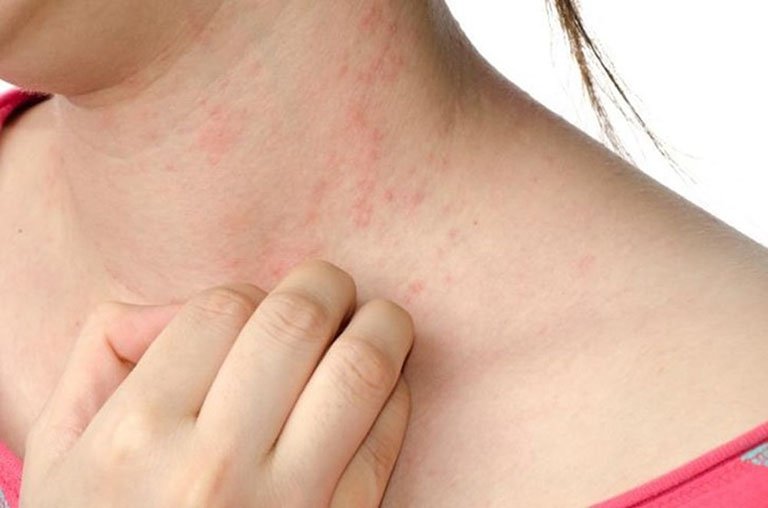 Thường xuyên nổi mẩn da và nóng dẫn đến toát mồ hôi nhiều là dấu hiệu của bệnh gì?
