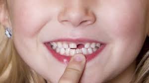 Bé 6 tuổi đã rụng răng vĩnh viễn có mọc lên lại được không?