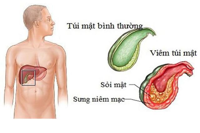 Bệnh Crohn và bệnh túi mật