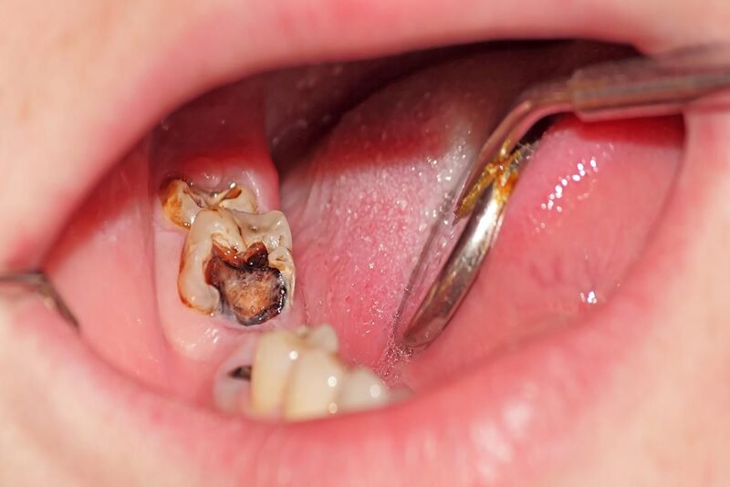 Tiền sử tai biến có nên nhổ răng hàm sâu kèm sưng không?