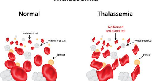 Beta thalassemia vẩy