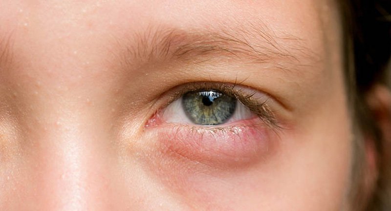 Đau vùng xung quanh mắt trái sau khi ngủ dậy là dấu hiệu bệnh gì?