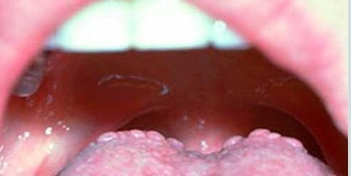 Cuống lưỡi nổi mụn nhỏ là dấu hiệu bệnh gì?