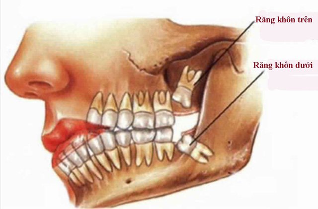 Nhổ răng khôn phải nhổ cả hàm trên và dưới đúng không?