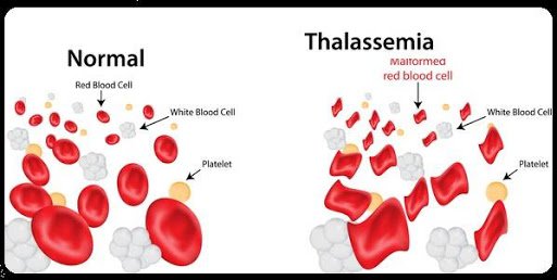 Bệnh thiếu máu thalassemia