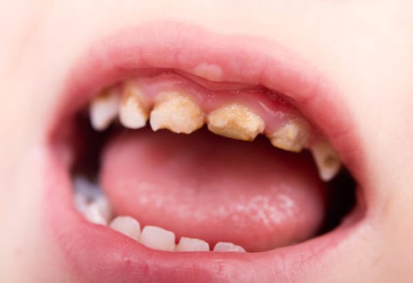 Trẻ 3-4 tuổi bị sâu răng hàm 55-65 khuyết còn chân răng có nhổ được không?
