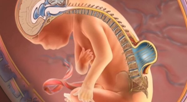 Nguyên nhân thai nhi bị dị tật khe hở cột sống?