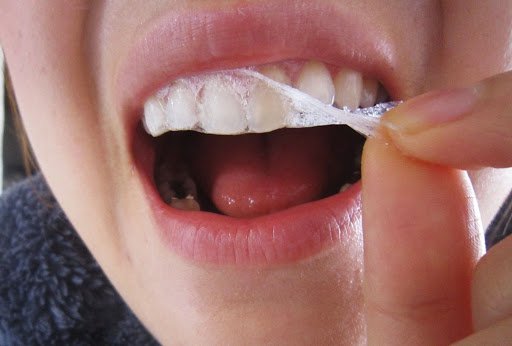 Tác hại của miếng dán trắng răng có thể ảnh hưởng tới ngà răng nếu dùng không đúng cách