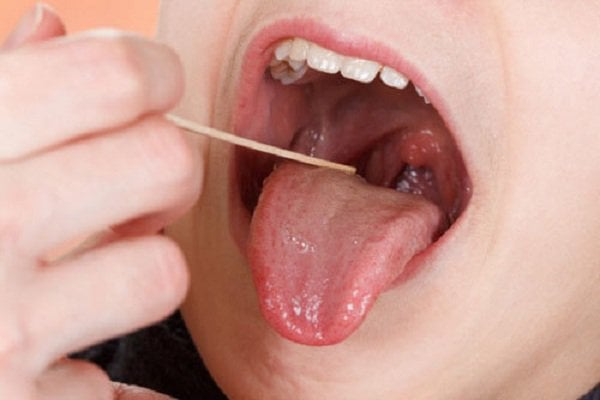 Mọc mụn mủ trong miệng là dấu hiệu của bệnh gì?
