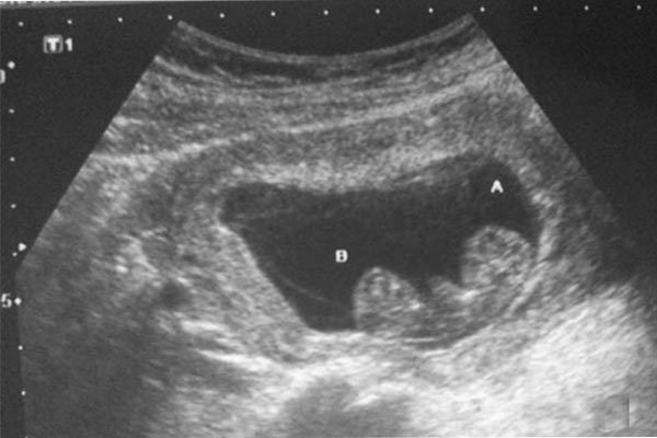 hình ảnh siêu âm thai