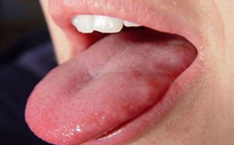Rát lưỡi kèm nổi u ở bờ lưỡi có phải ung thư lưỡi không?