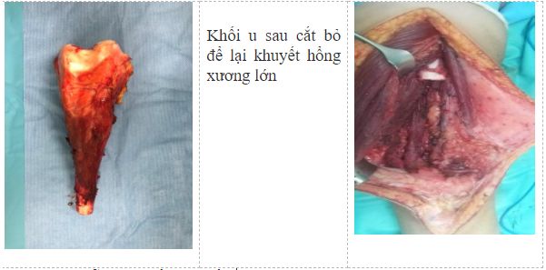 Hình ảnh phẫu thuật lấy bỏ khối u