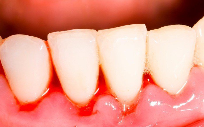 Nam giới chảy máu chân răng nguyên nhân là gì?