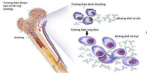 Phương pháp điều trị u tế bào ống nội tuỷ loại có điền xếp?