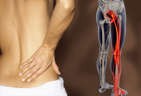 Đau vùng thắt lưng bên phải lan xuống mông và đùi sau là bệnh lý gì?